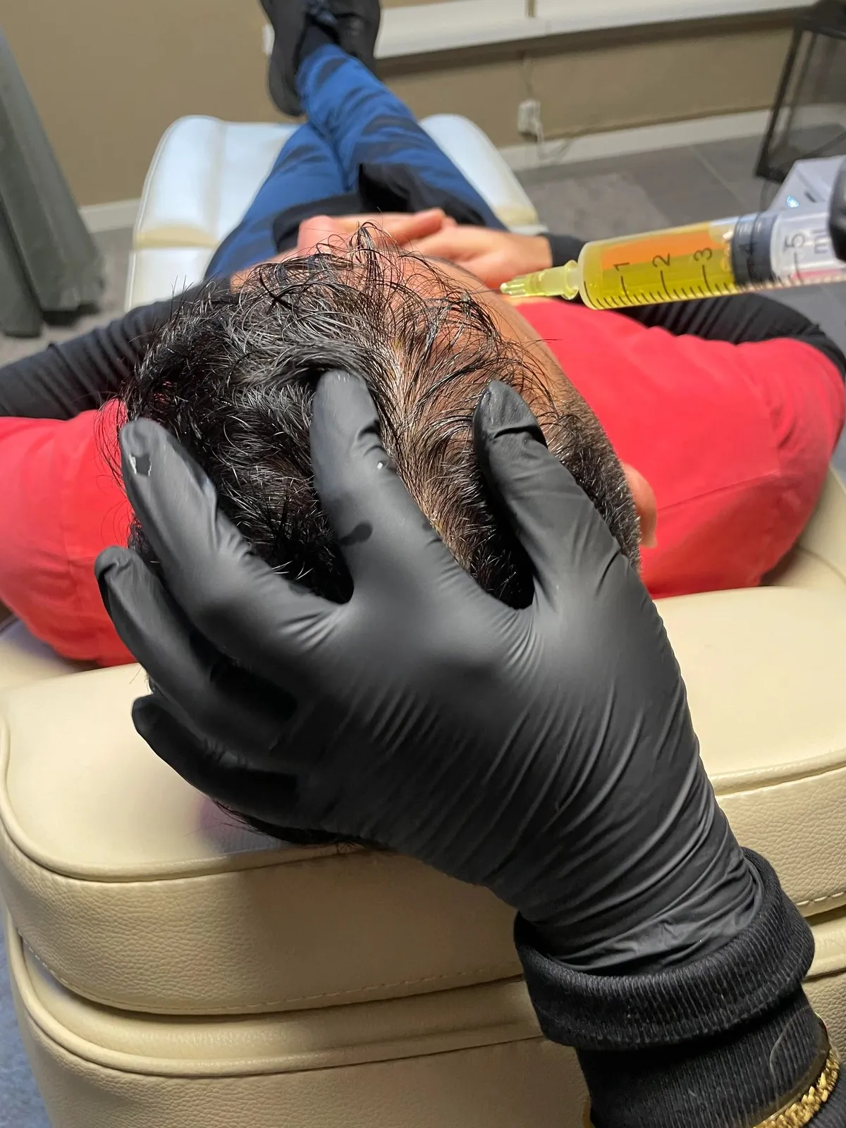PRP-behandling af hovedbund